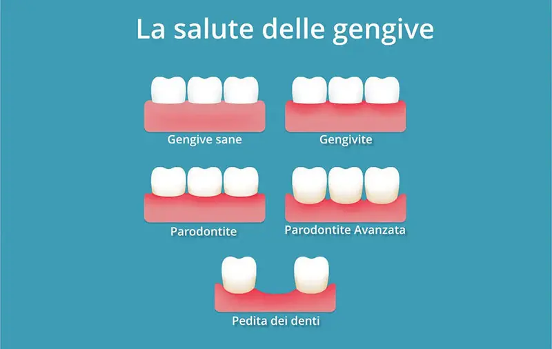 Studio Dentistico Marzulli Bari Cura Piorrea e Parodontite_2