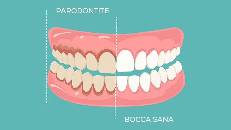 Studio Dentistico Marzulli Bari Cura Piorrea e Parodontite_3