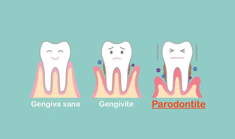 Studio Dentistico Marzulli Bari Cura Piorrea e Parodontite_4