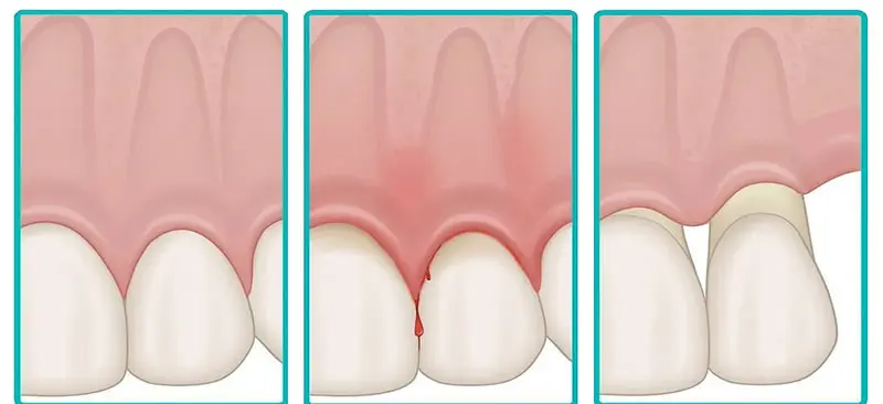 Studio Dentistico Marzulli Bari Cura Piorrea e Parodontite_5