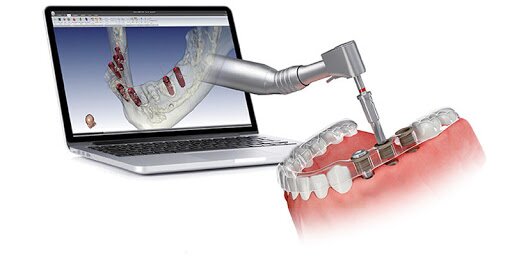 Dentista Convenzionato R. Marzulli Bari Implantologia Computer Guidata