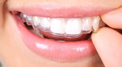 Dentista Convenzionato R. Marzulli Bari Ortodonzia invisibile INVISALIGN