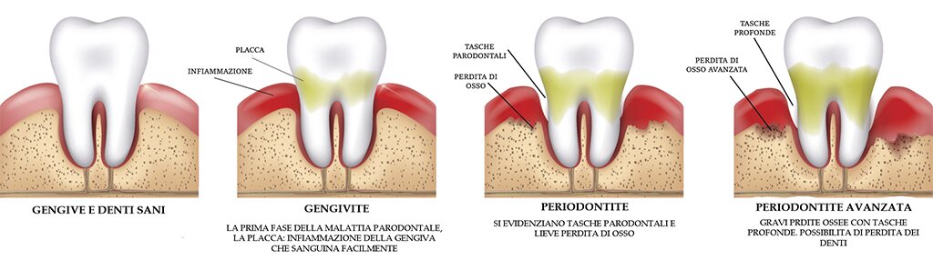 Dentista Convenzionato R. Marzulli Bari Cura Parodontite e Piorrea