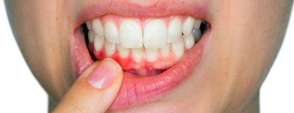 Dentista Convenzionato R. Marzulli Bari Cura Parodontite e Piorrea