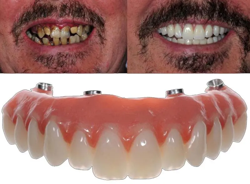 dentistamarzullibari_protesifissa1 dentistamarzullibari_protesifissa1