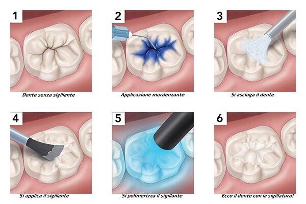 Dentista Convenzionato R. Marzulli Bari Odontoiatria Infantile